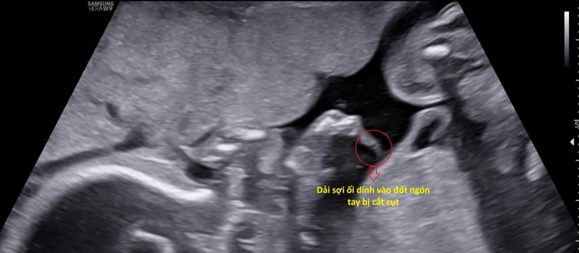 Hội chứng Dải sợi ối (Amniotic Band Syndrome - ABS)