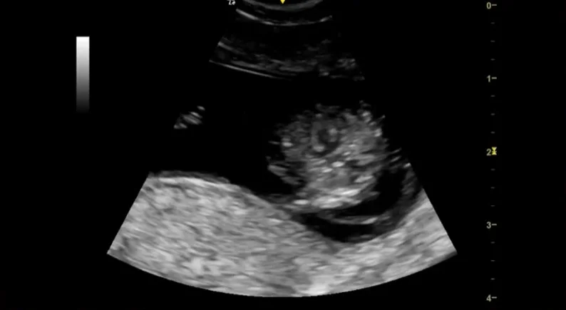 Hội chứng đa màng cánh (Multiple Pterygium Syndromes - Cứng đa khớp)