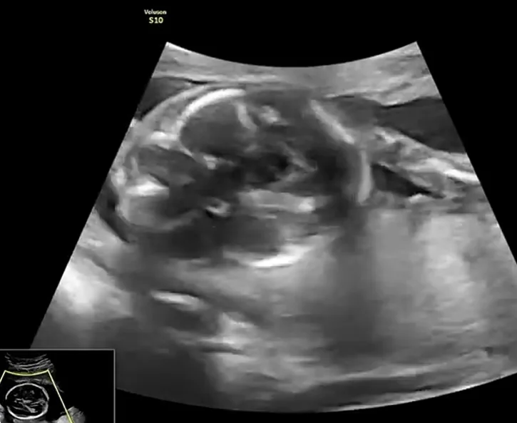 Hội chứng Joubert thai nhi (Dấu hiệu răng hàm ở tiểu não)