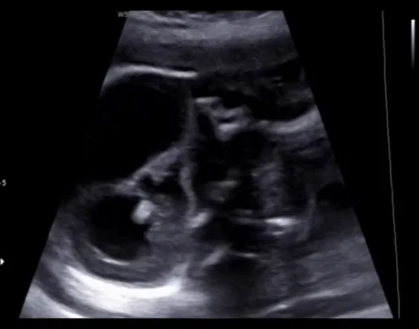 Hội chứng Walker-Warburg (Loạn dưỡng Cơ - Não - Mắt)