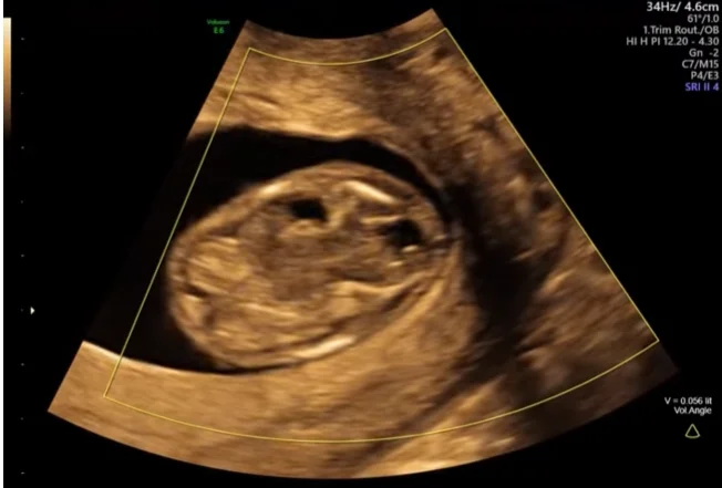 Hội chứng Meckel-Gruber (Tam chứng: Thoát vị não, đa nang thận, đa ngón)