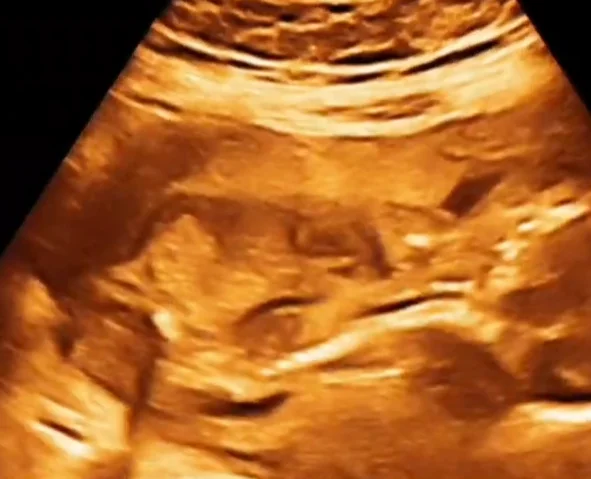 Phức hợp VACTERL (Phối hợp dị tật cột sống, hậu môn, tim, thận...)