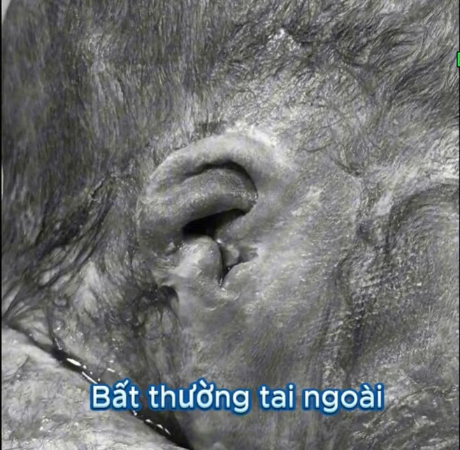 Hội chứng CHARGE (Mắt, tim, mũi, sinh dục, tai)