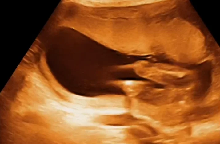 Hội chứng Holt-Oram (Hội chứng Tim - Tay)