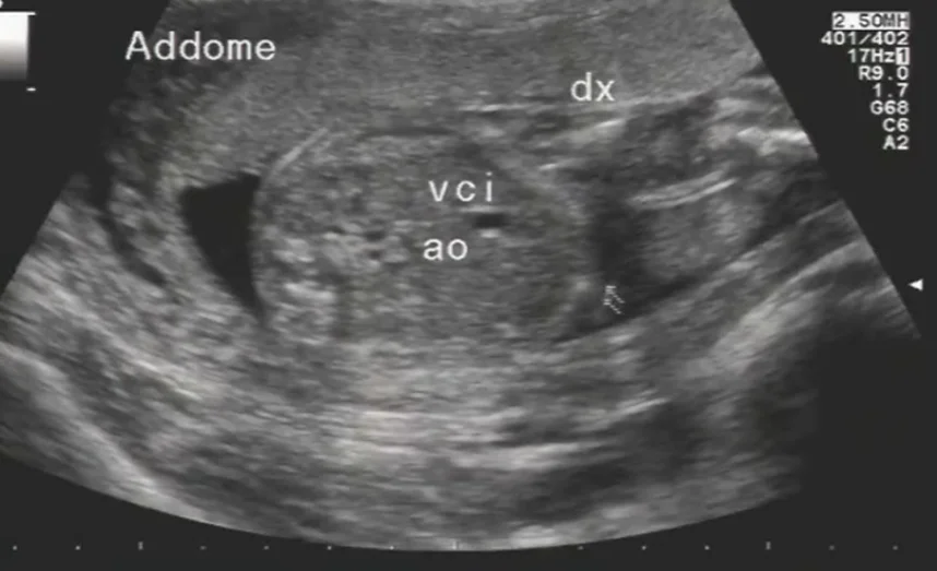 Hội chứng Fryns (Thoát vị hoành, mặt thô, teo đầu chi).