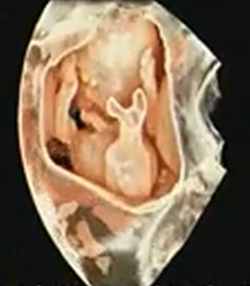 Hội chứng Nàng tiên Cá (Sirenomelia)