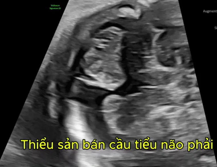 Hội chứng PHACES ở thai (U máu mặt lớn và dị tật phối hợp)