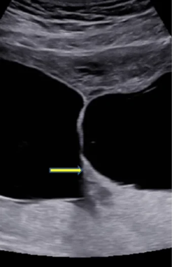 Bánh nhau -  túi ối trong song thai (Chorionicity- Amnionicity)
