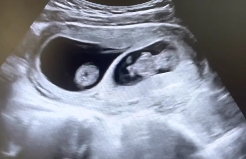 Song thai hai nhau - hai ối (Dichorionic Diamniotic Twins - DCDA)