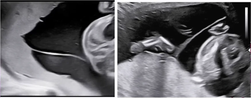 Song thai một nhau - hai ối (Monochorionic Diamniotic Twins - MCDA)