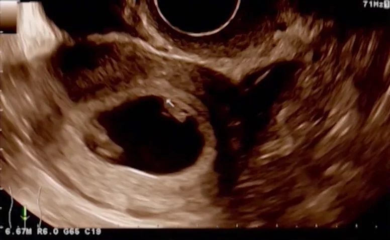 Song thai một nhau - một ối (Monochorionic Monoamniotic - MCMA)