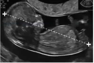 Dán nhãn và đánh giá tương hợp Song thai (Fetal Labeling &amp; Concordance Assessment)