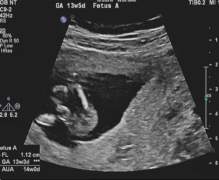 Dây rốn quấn nhau ở song thai (Cord entanglement)