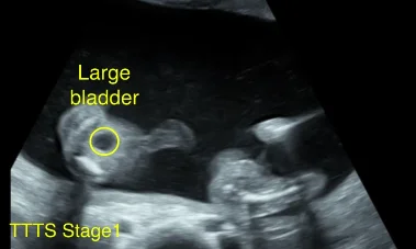 Hội chứng truyền máu song thai (Twin-Twin Transfusion Syndrome - TTTS)