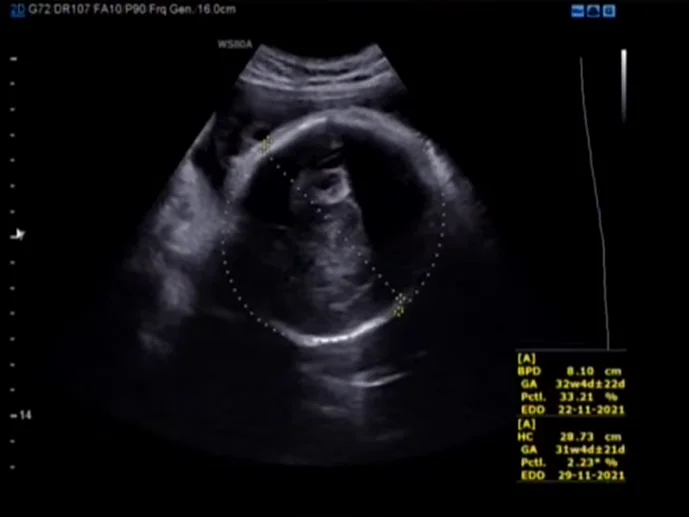 Thai chậm tăng trưởng chọn lọc trong sinh đôi (Selective Fetal Growth Restriction - sFGR)