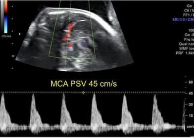 Hội chứng thiếu máu – đa hồng cầu Song thai (Twin Anemia-Polycythemia Sequence - TAPS)