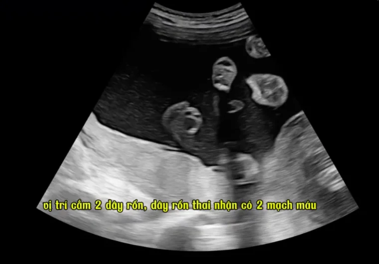 Hội chứng Đảo ngược tưới máu động mạch Song thai một bánh nhau (Twin Reversed Arterial Perfusion - TRAPS)