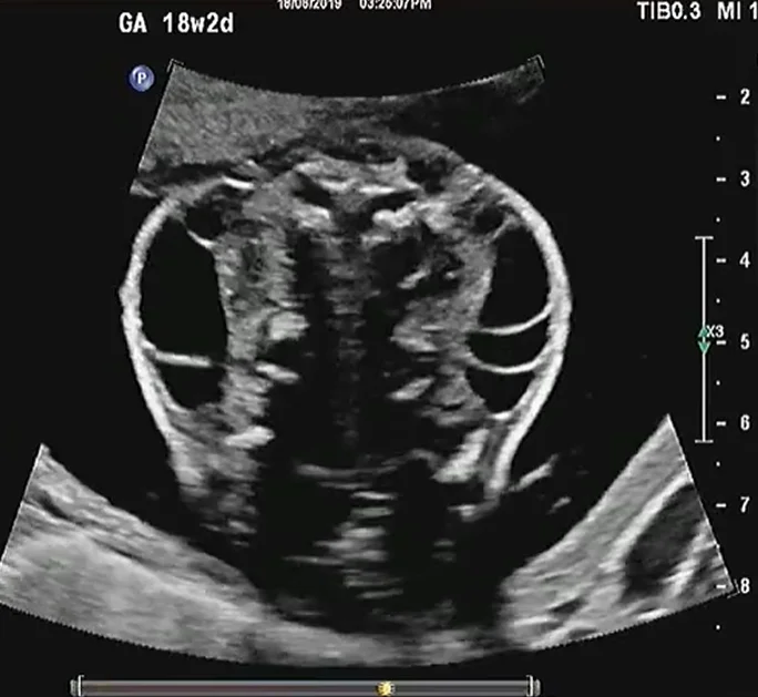 Song thai dính liền (Conjoined Twins)