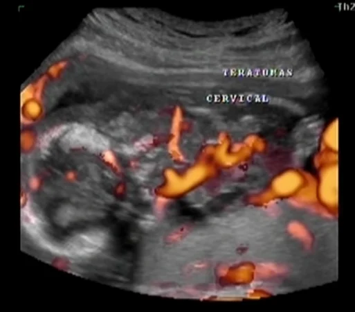 Thai trong thai (Fetus-in-Fetu - FIF)