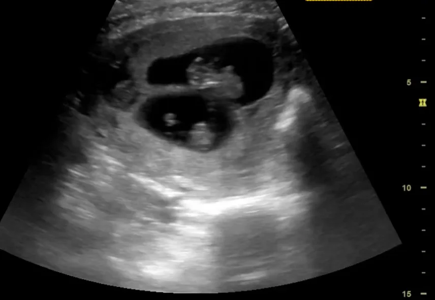 Sinh ba và đa thai bậc cao (Triplets and Beyond)