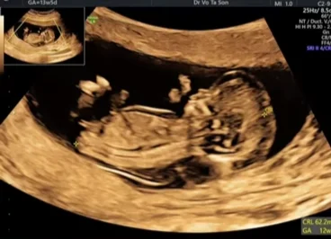 Bất thường hình thái không đồng thời ở song thai (Discordant Anomalies)