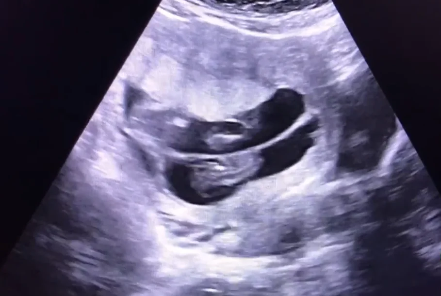 Thai lưu một bé trong đa thai (Single Fetal Demise - sIUFD)