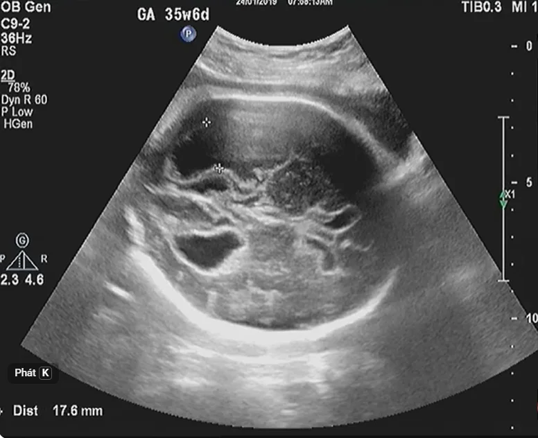 Nhiễm Cytomegalovirus (CMV) bào thai