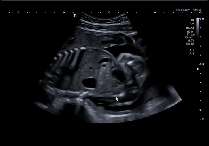 Nhiễm Parvovirus B19 bào thai