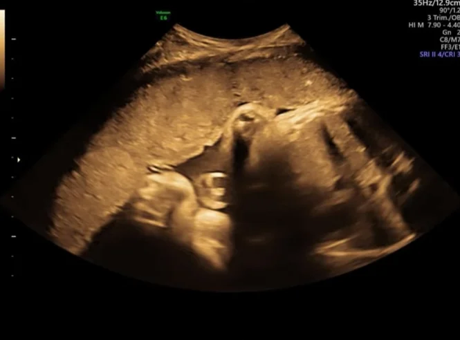 Nhiễm trùng Toxoplasma bào thai