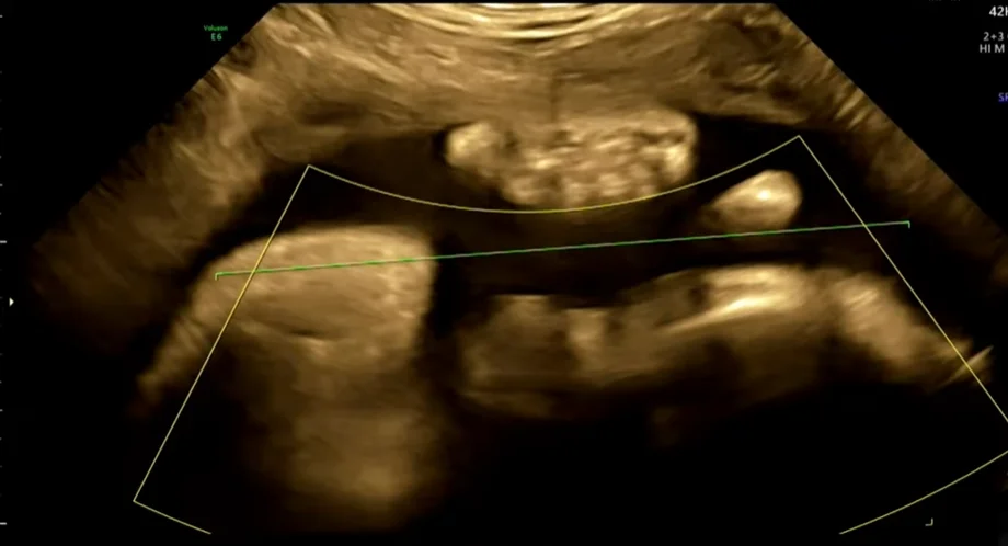 Thai to (Macrosomia)