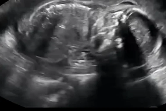 Thiểu ối và vô ối (Oligohydramnios &amp; Anhydramnios).