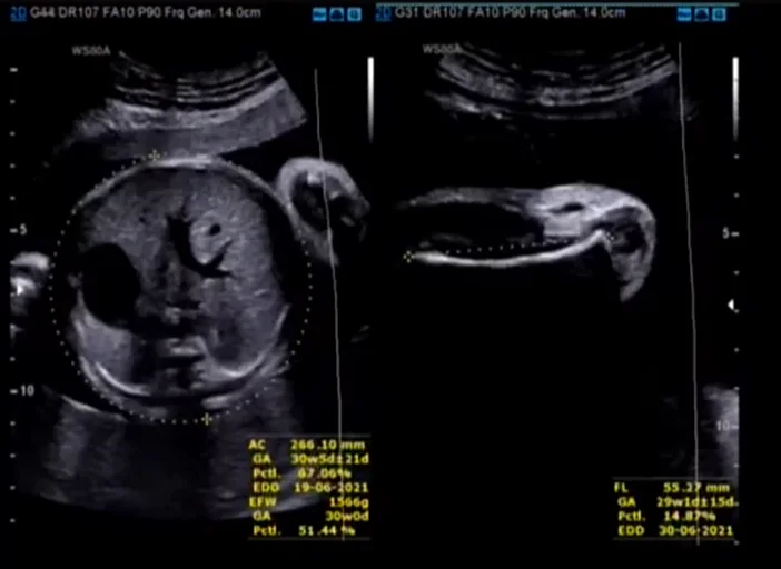 Đa ối (Polyhydramnios)