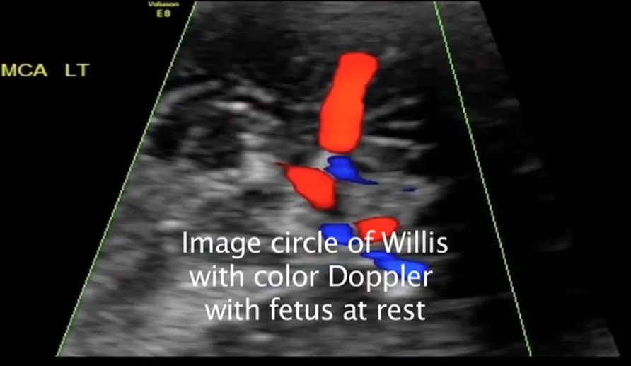 Thiếu máu thai nhi (Fetal Anemia)