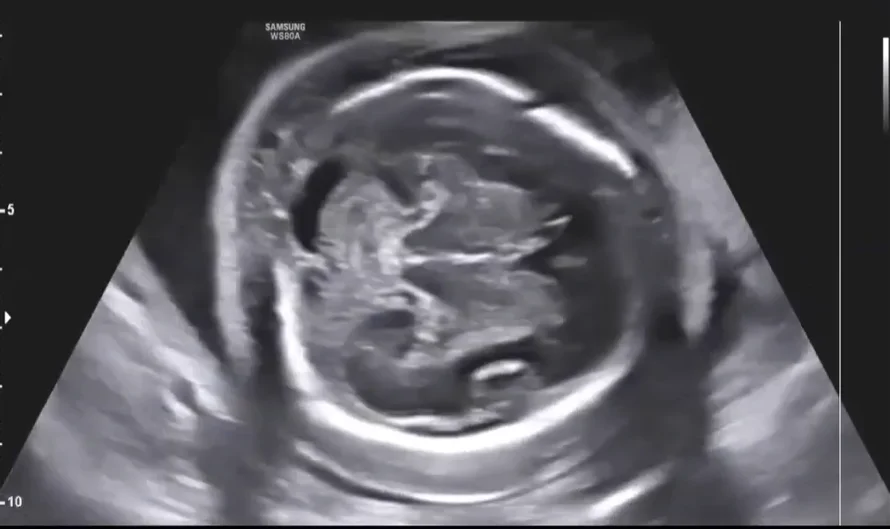 Phù thai (Hydrops Fetalis)