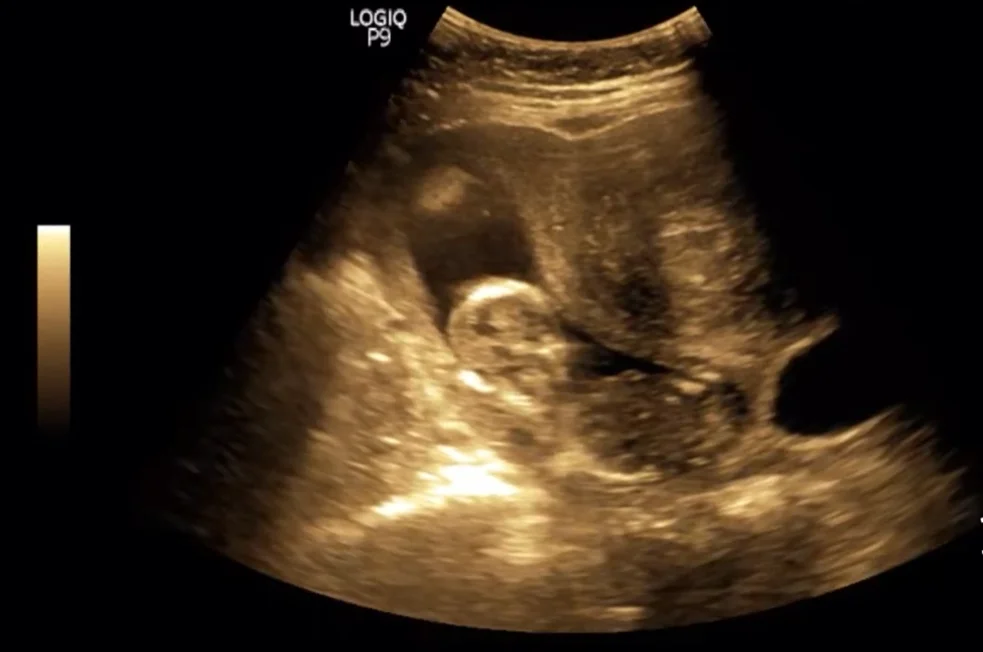 U xơ tử cung trong thai kỳ (Myoma in Pregnancy)