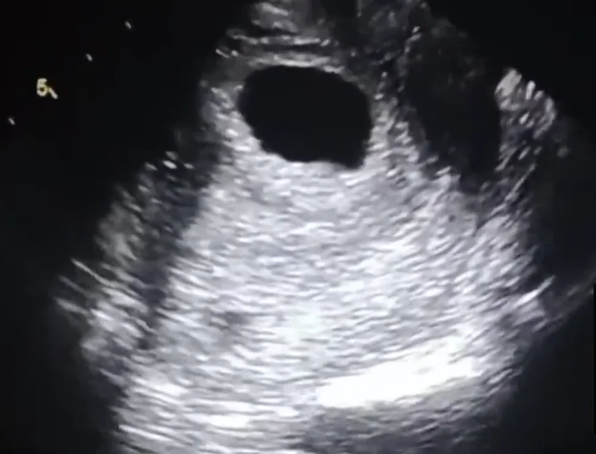 Dị dạng tử cung trong thai kỳ (Müllerian Duct Anomalies in Pregnancy)