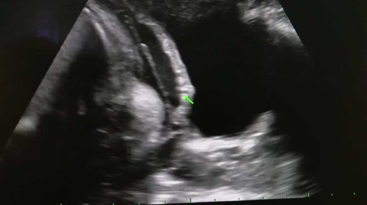 Mất liên tục và vỡ tử cung (Uterine Dehiscence/Rupture)