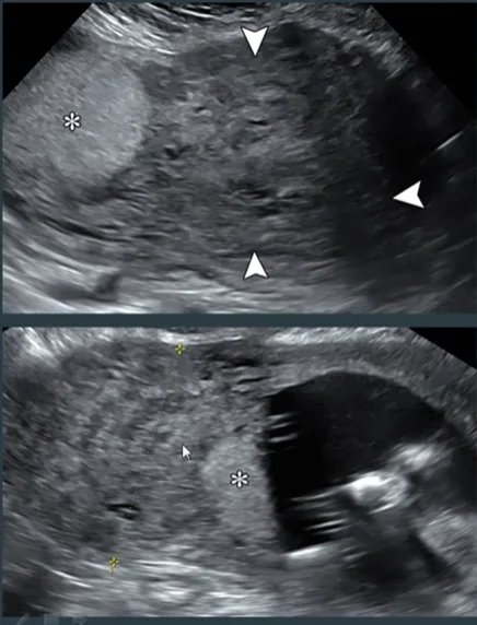 Lạc nội mạc trong cơ tử cung (Adenomyosis) trong thai kỳ