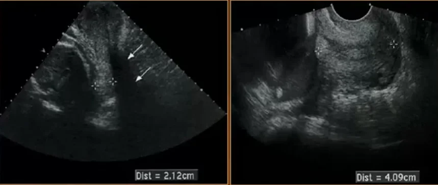 Hở eo tử cung và cổ tử cung ngắn (Cervical Insufficiency / Short Cervix)