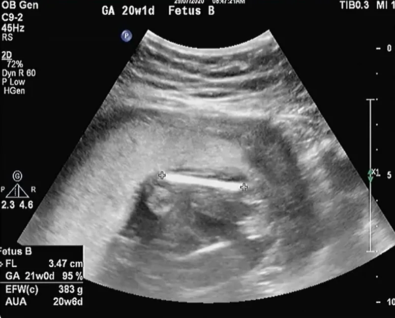 Đánh giá khâu eo tử cung (Cervical Cerclage)