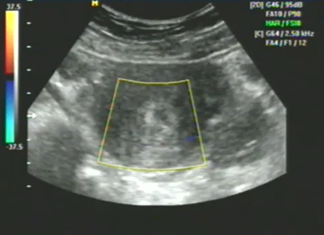Sót nhau (Retained Products of Conception - RPOC)