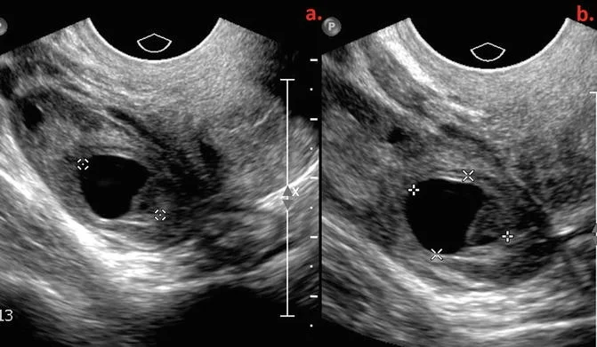 Khối u phần phụ trong thai kỳ (Adnexal Mass in Pregnancy)