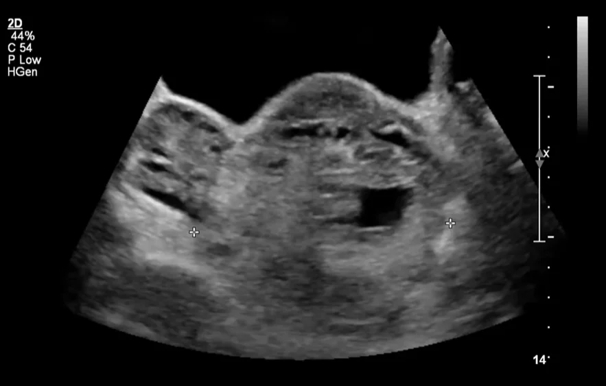 Xoắn buồng trứng trong thai kỳ (Ovarian Torsion in Pregnancy).