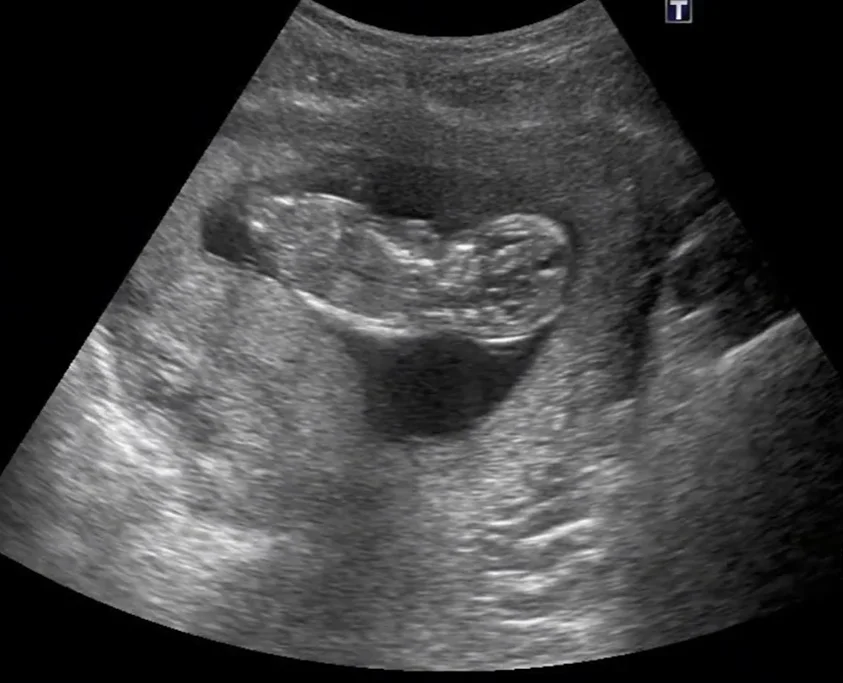 Viêm ruột thừa trong thai kỳ (Acute Appendicitis in Pregnancy)