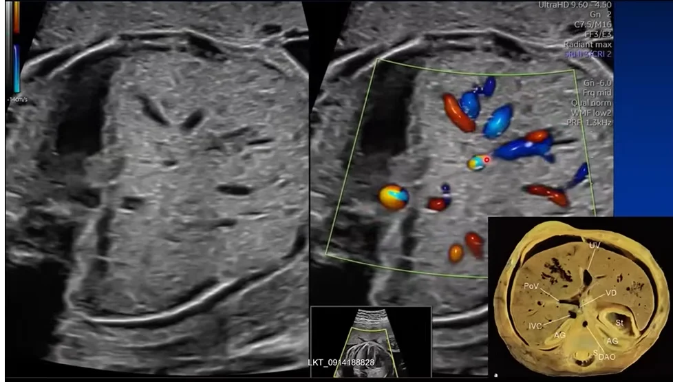 Các mặt cắt siêu âm tim thai (Guidelines for Fetal Cardiac Imaging)