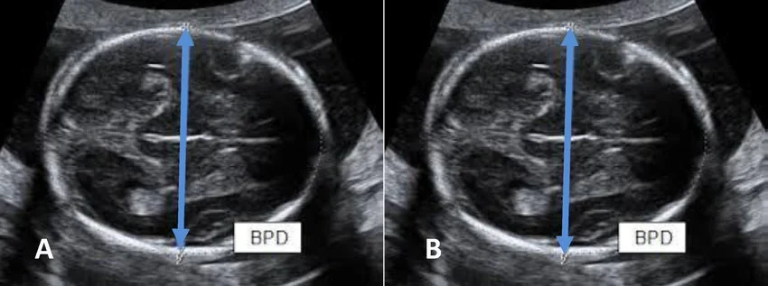 Sinh trắc học thần kinh thai