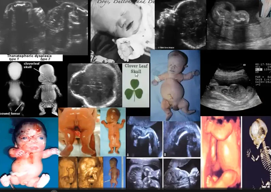 Tổng quan cơ xương khớp thai nhi (Approach to fetal skeletal)