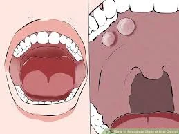 Phân loại giai đoạn Ung thư biểu mô Khoang miệng (Oral cavity carcinoma (staging))