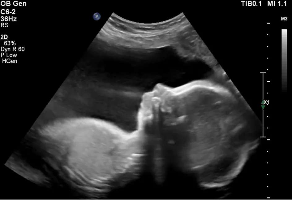 Chuỗi Pierre Robin thai nhi (Pierre Robin Sequence) - đầu mặt