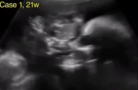 U quái vùng hầu họng thai (Epignathus)